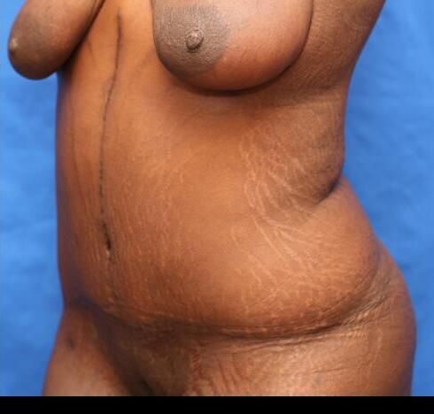 Post Massive Weight Loss Surgery Before & After