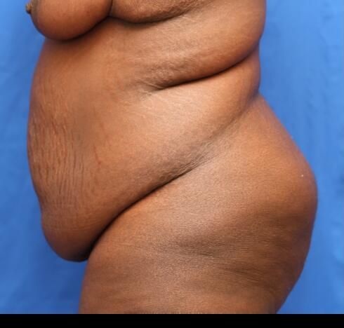 Post Massive Weight Loss Surgery Before & After