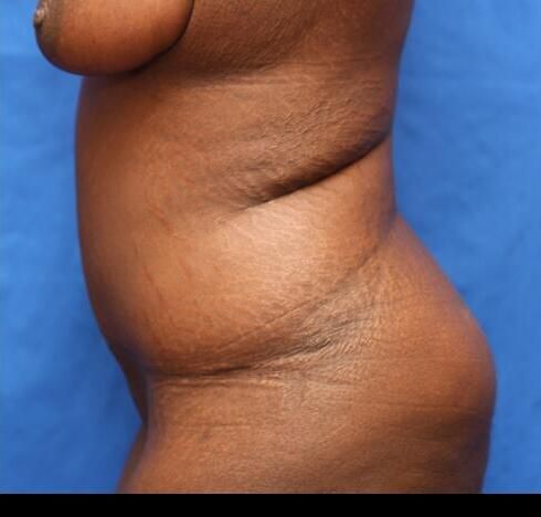 Post Massive Weight Loss Surgery Before & After