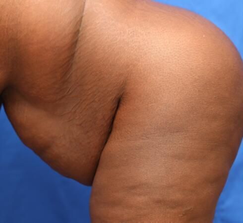 Post Massive Weight Loss Surgery Before & After