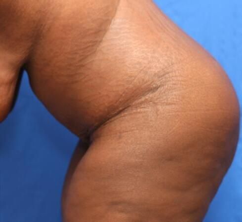 Post Massive Weight Loss Surgery Before & After