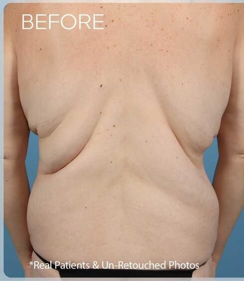 Post Massive Weight Loss Surgery Before & After