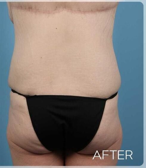 Post Massive Weight Loss Surgery Before & After