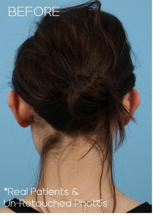 Otoplasty Before & After