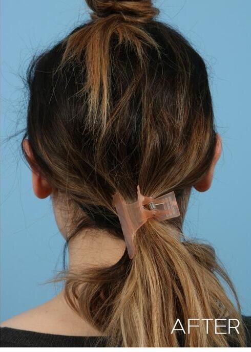 Otoplasty Before & After