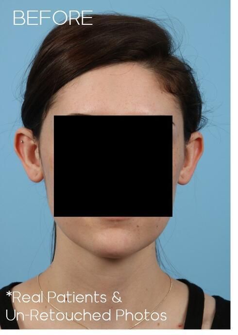 Otoplasty Before & After