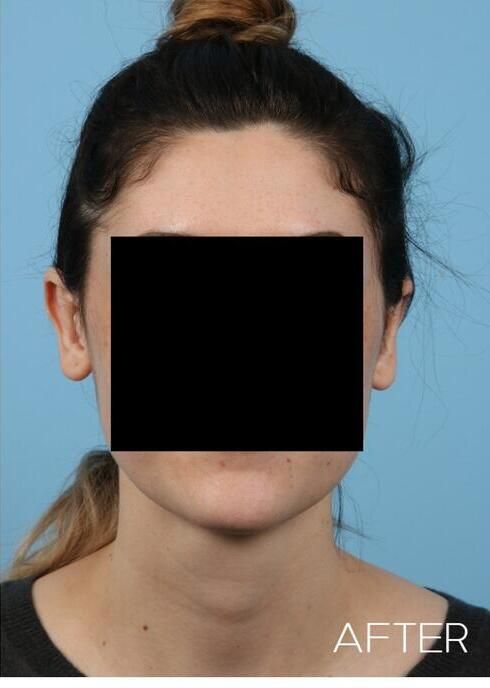 Otoplasty Before & After