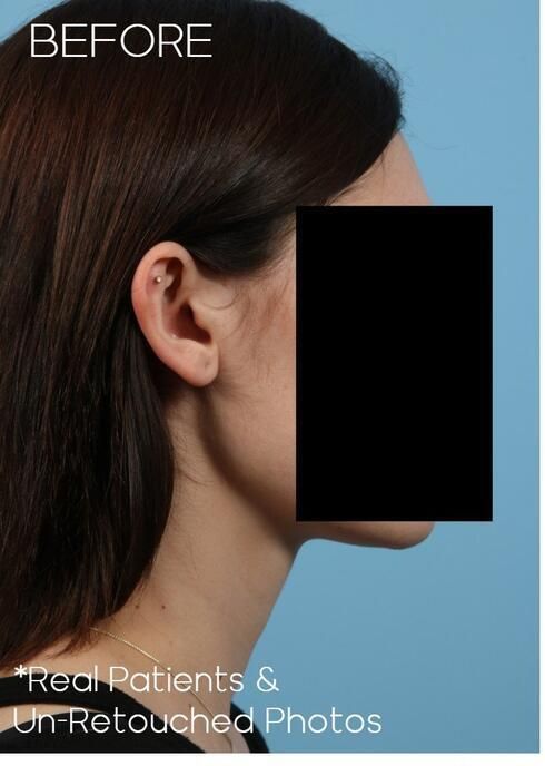 Otoplasty Before & After