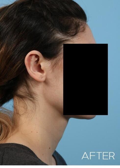 Otoplasty Before & After