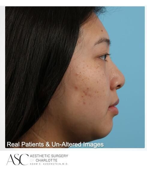 Liposuction Before & After