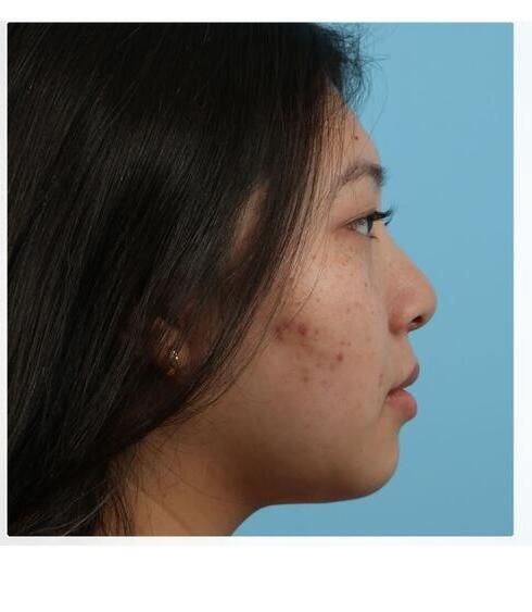 Liposuction Before & After