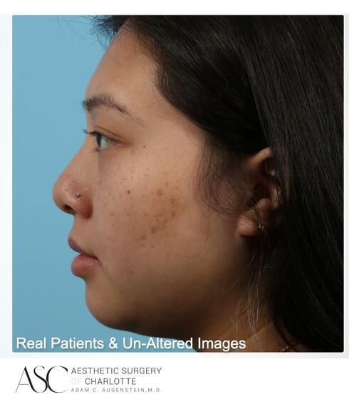 Liposuction Before & After