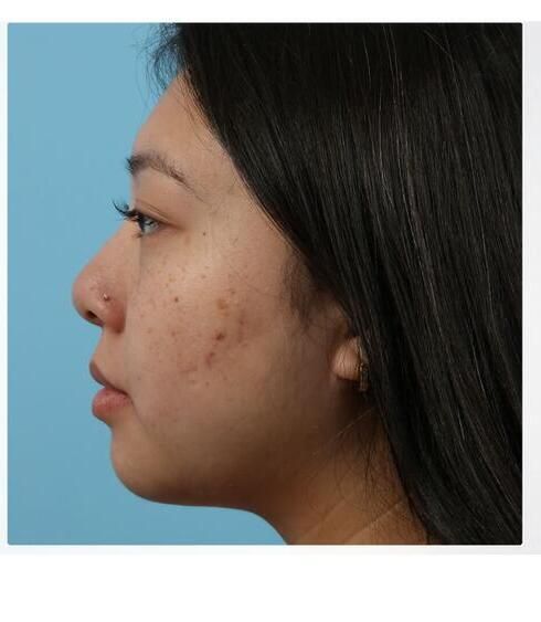 Liposuction Before & After