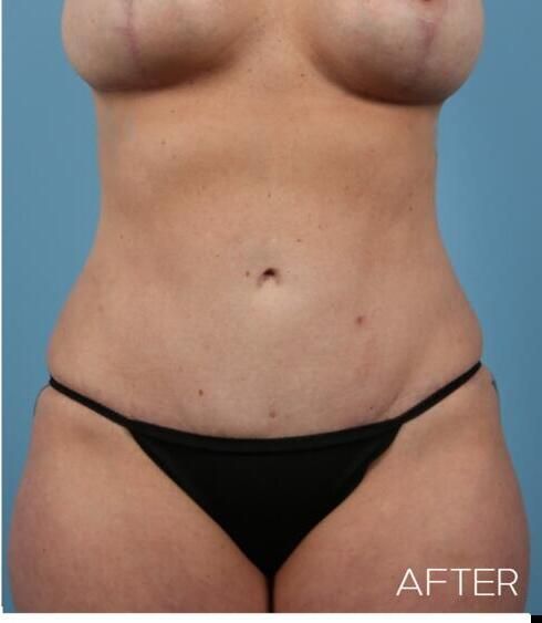 Liposuction Before & After
