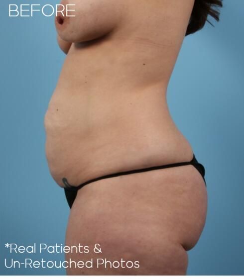 Liposuction Before & After