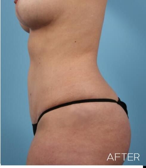 Liposuction Before & After