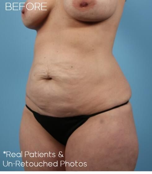 Liposuction Before & After