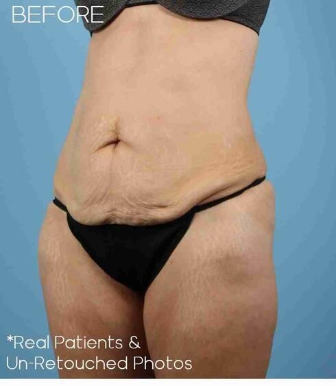 Liposuction Before & After