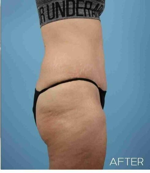 Liposuction Before & After