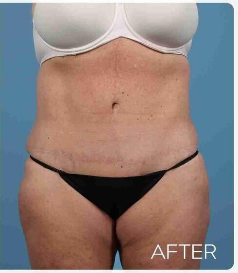 Liposuction Before & After