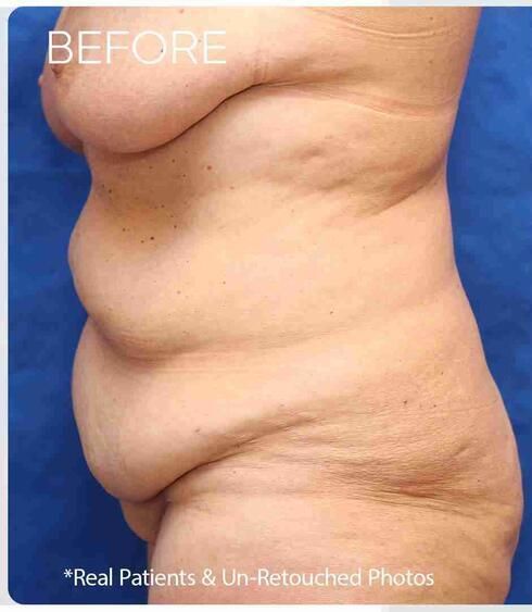 Liposuction Before & After