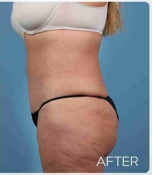 Liposuction Before & After