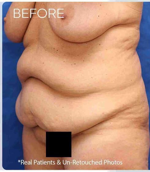 Liposuction Before & After