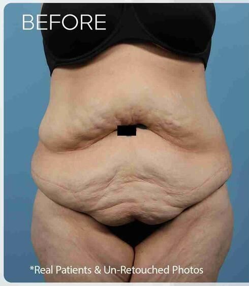 Liposuction Before & After