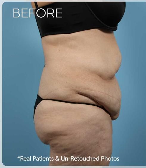 Liposuction Before & After
