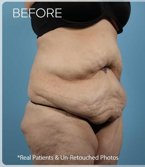 Liposuction Before & After