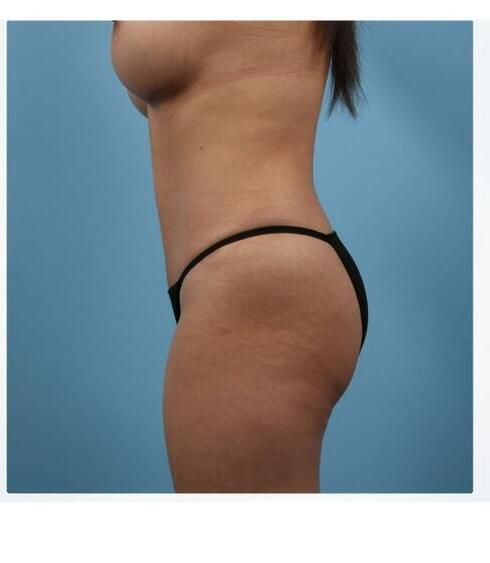 Breast Augmentation Before & After