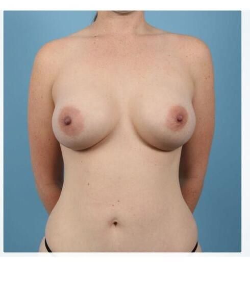 Breast Augmentation Before & After
