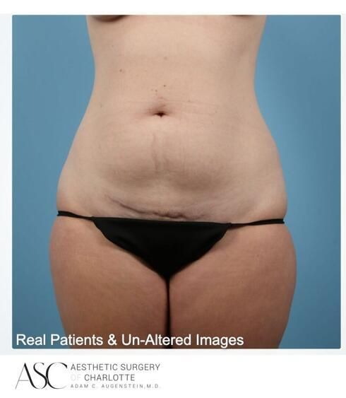 Breast Augmentation Before & After