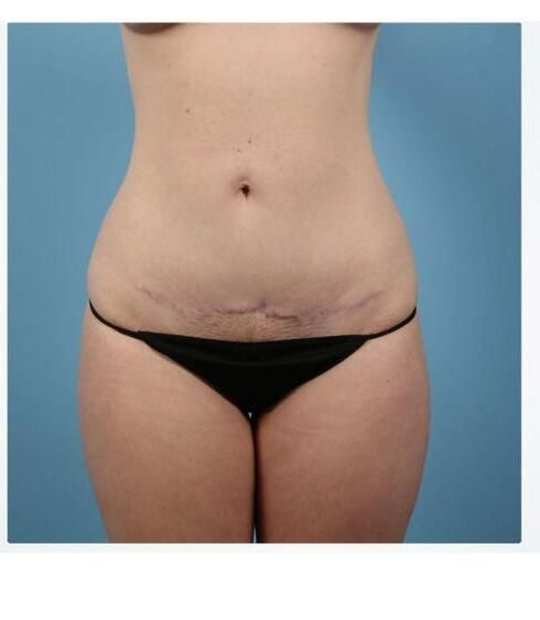 Breast Augmentation Before & After