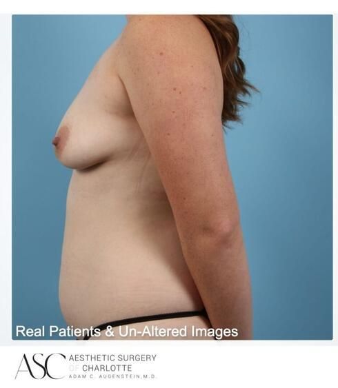 Breast Augmentation Before & After