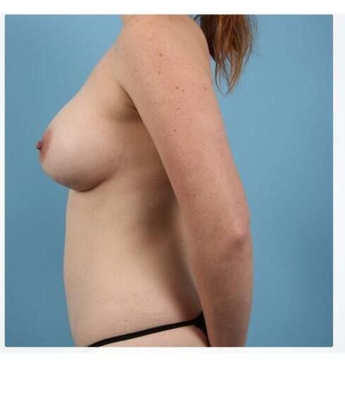 Breast Augmentation Before & After