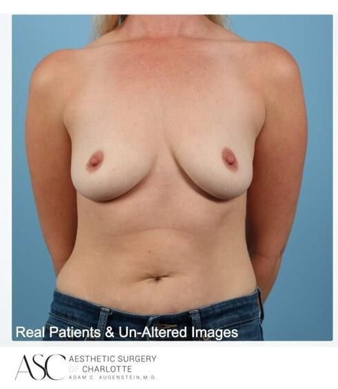 Breast Augmentation Before & After