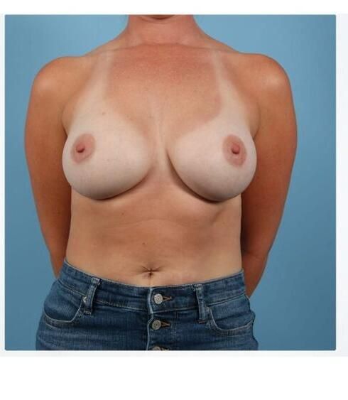 Breast Augmentation Before & After
