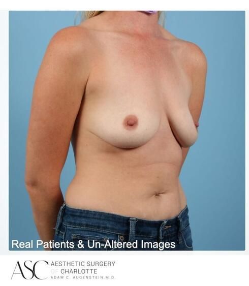 Breast Augmentation Before & After