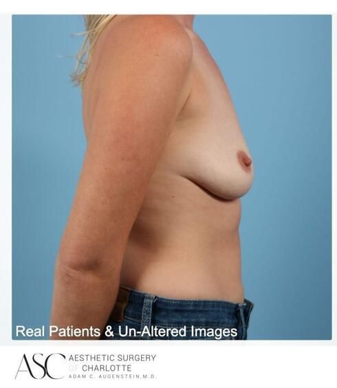 Breast Augmentation Before & After