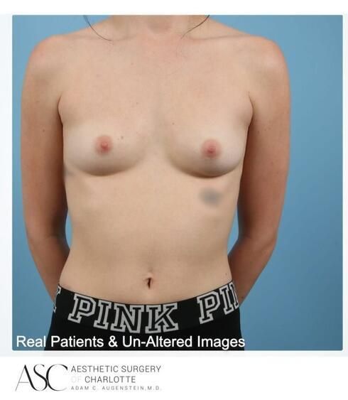 Breast Augmentation Before & After