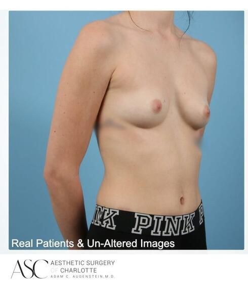 Breast Augmentation Before & After