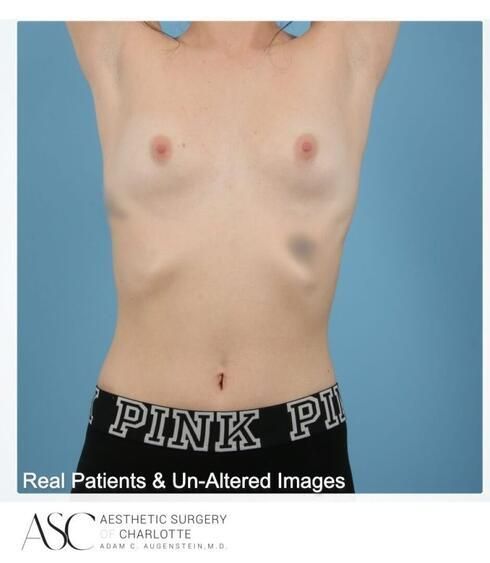 Breast Augmentation Before & After