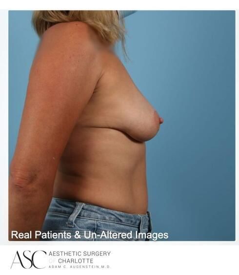Breast Augmentation Before & After