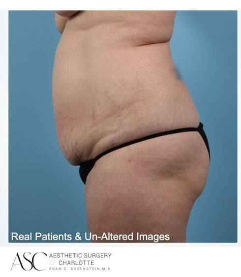 Breast Augmentation Before & After