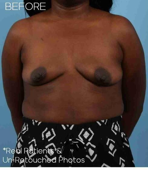 Breast Augmentation Before & After