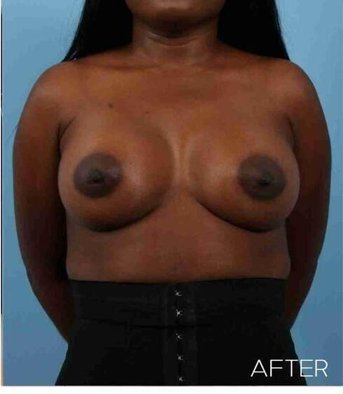 Breast Augmentation Before & After
