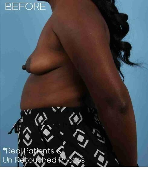 Breast Augmentation Before & After