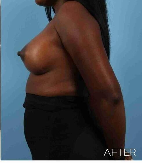 Breast Augmentation Before & After