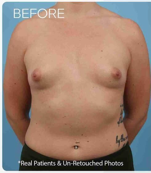 Breast Augmentation Before & After